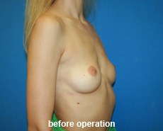 plastic-surgery-breast-augmentation